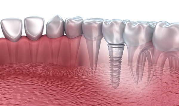 dental_implants_post